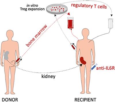 A Prospective Controlled Trial to Evaluate Safety and Efficacy of in vitro Expanded Recipient Regulatory T Cell Therapy and Tocilizumab Together With Donor Bone Marrow Infusion in HLA-Mismatched Living Donor Kidney Transplant Recipients (Trex001)